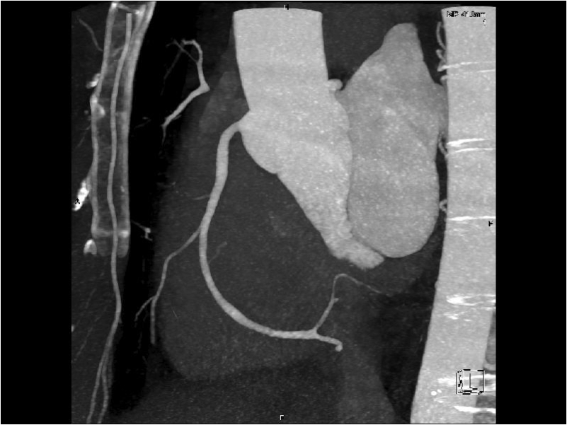 CT Coronary