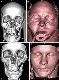 CT Craniofacial