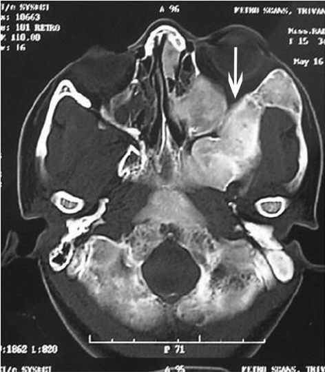 CT Craniofacial