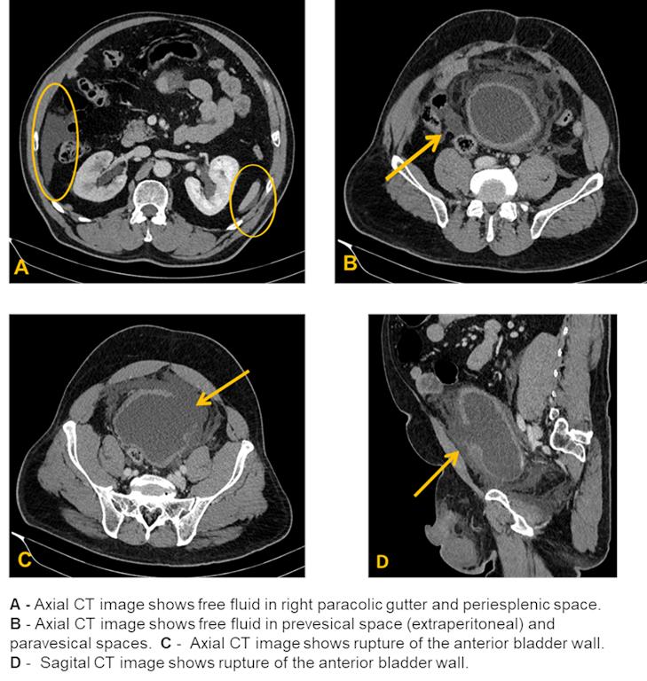 CT Cystogram