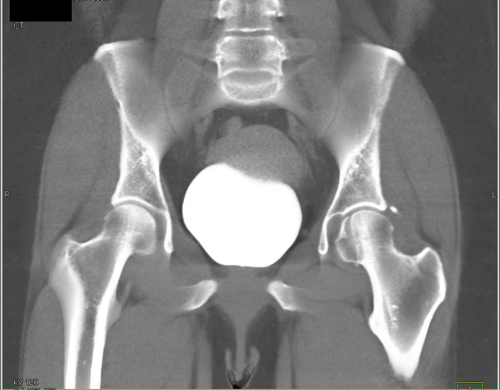 CT Cystogram