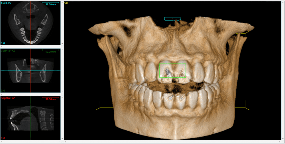 CT Dental Scan