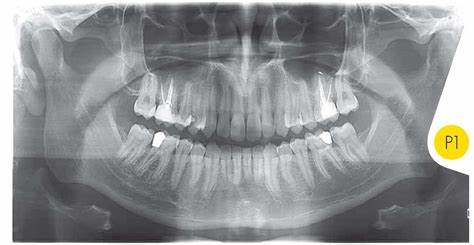 CT Dental Scan