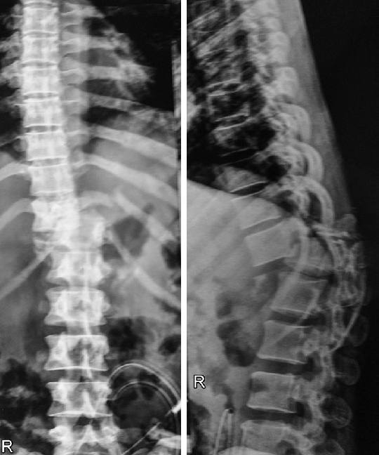 CT Dorsolumar Spine