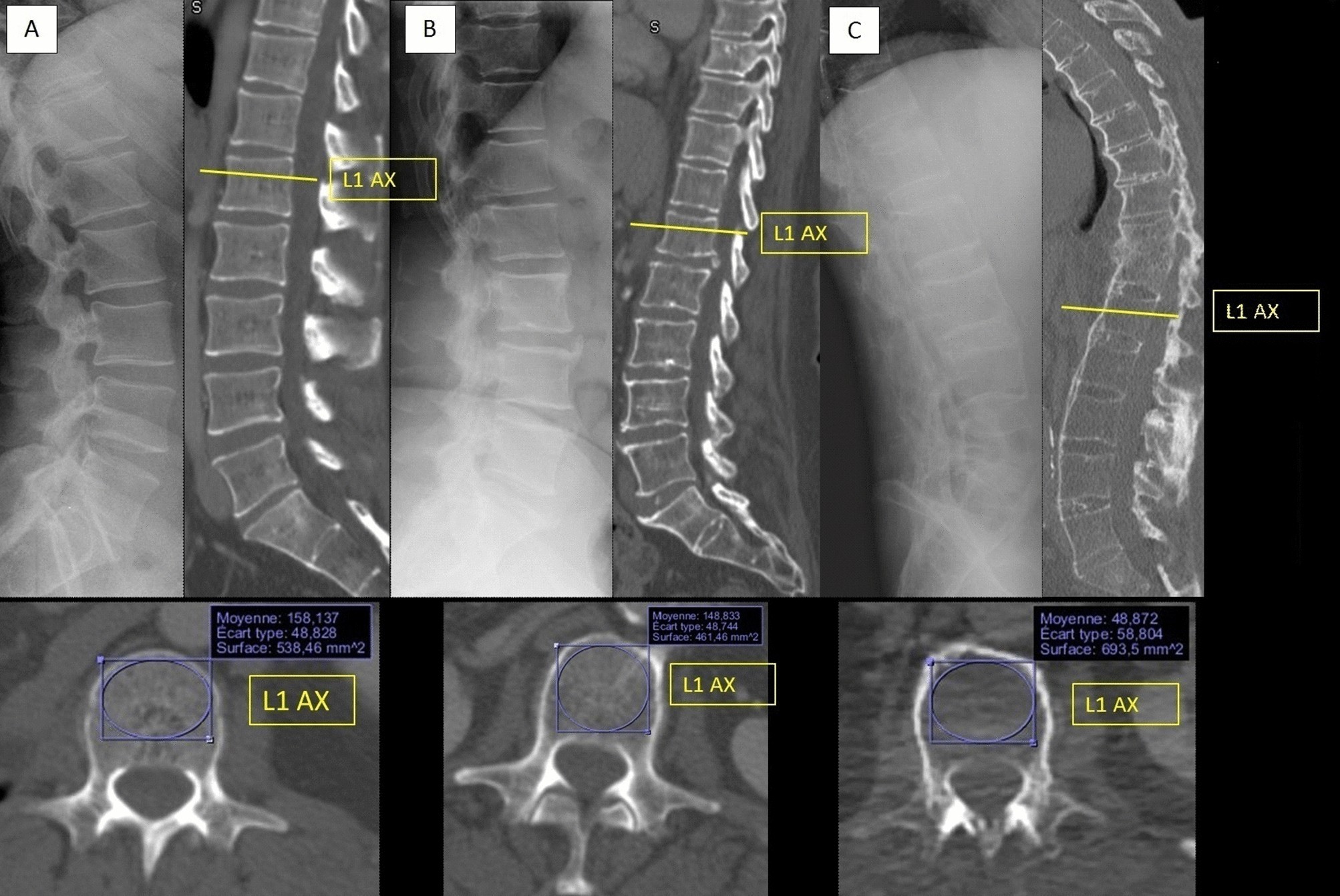 CT Dorsolumbar  Spine