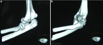 CT Elbow Left