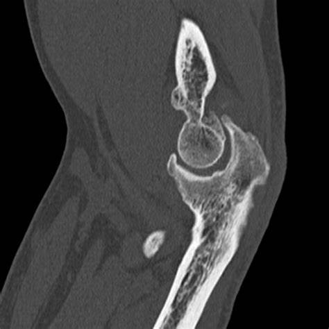 CT Elbow Left