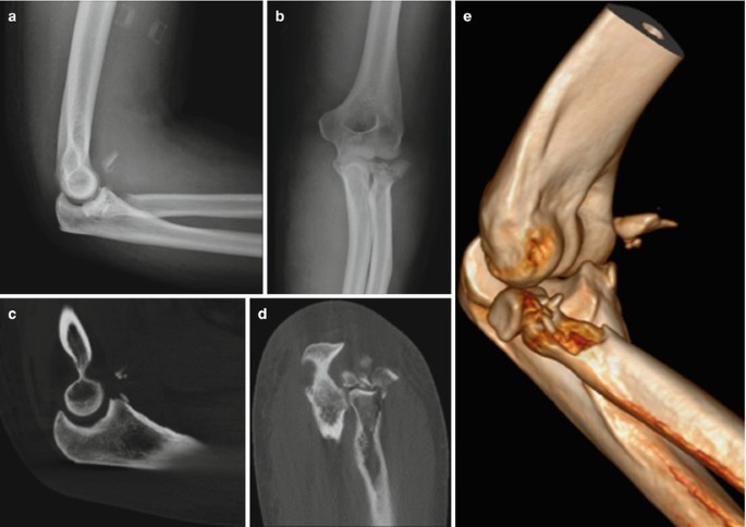 CT Elbow Right