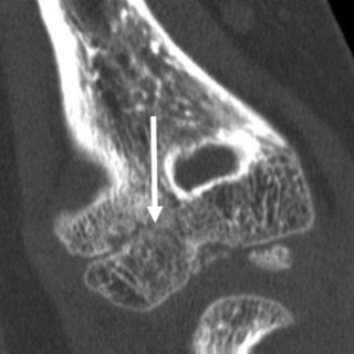 CT Elbow Right