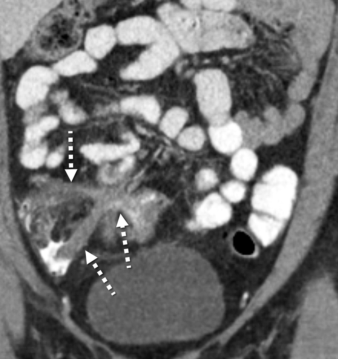 CT Enterography