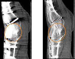 CT Extremity