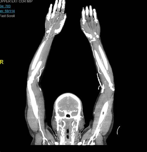 CT Extremity