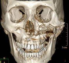 CT Facial Bones