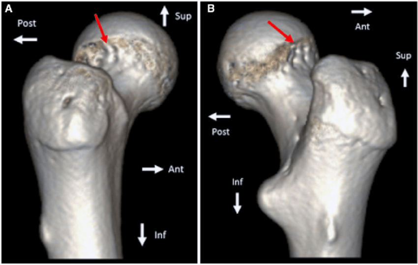 CT Femur