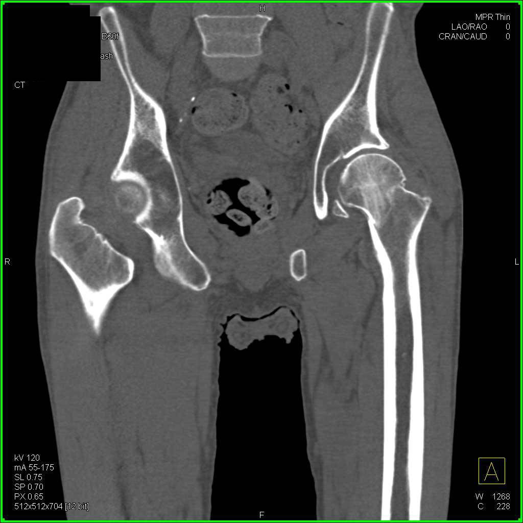 CT Femur