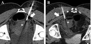 CT Guided drainage