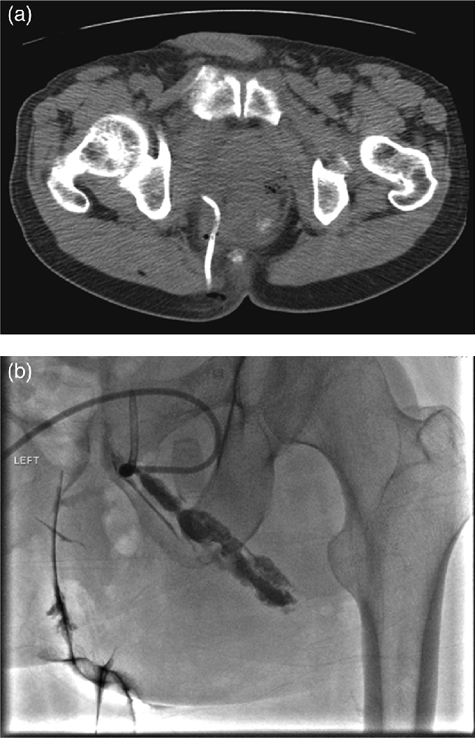 CT Guided drainage