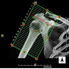 CT HUMERUS