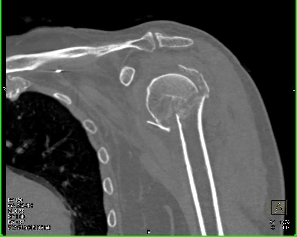 CT HUMERUS