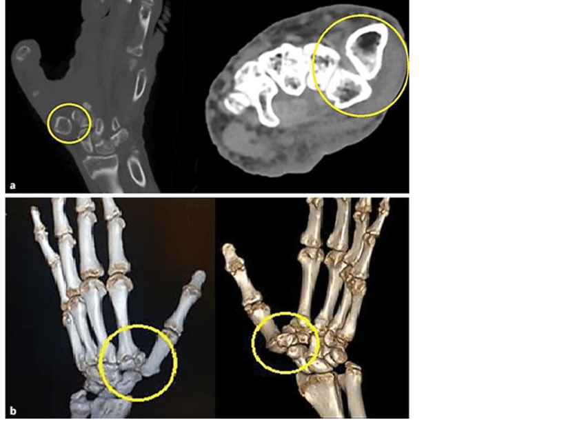 CT Hand