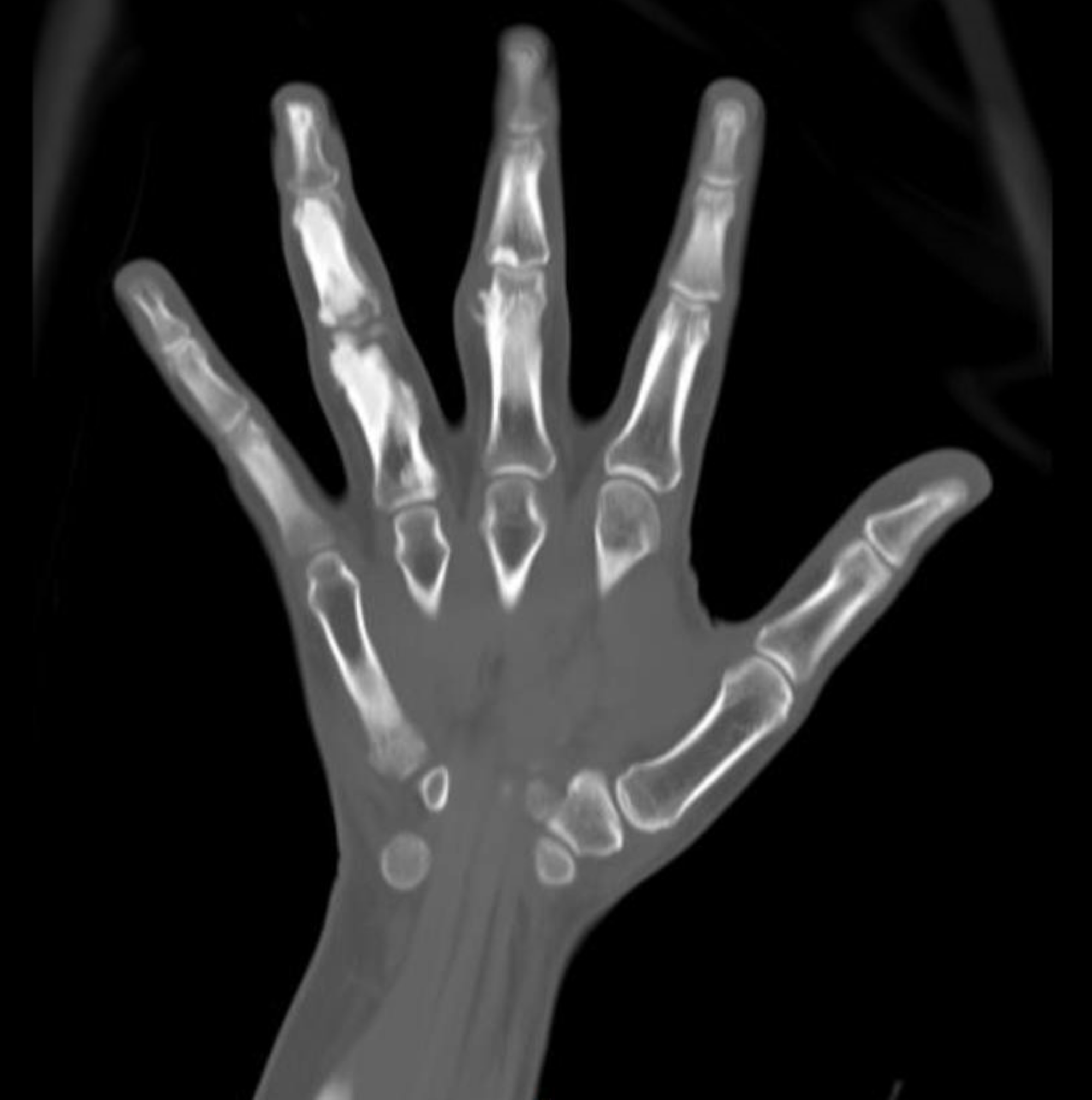 CT Hand