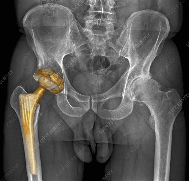 CT Hip Joint