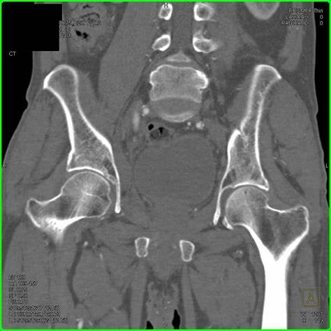 CT Hip Joint