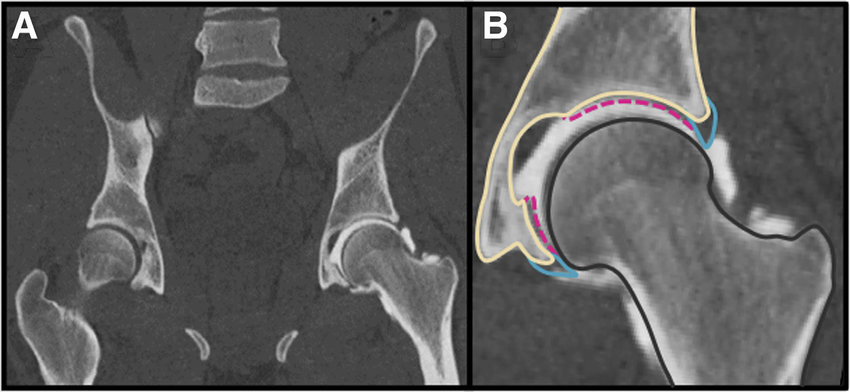 CT Hip Joint LEFT