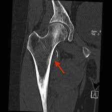 CT Hip Joint RIGHT