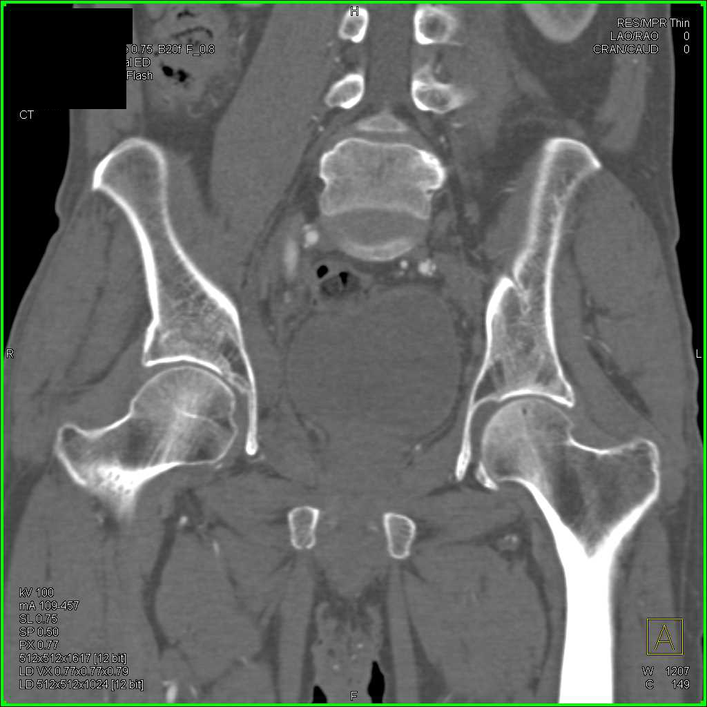 CT Hip Joint RIGHT