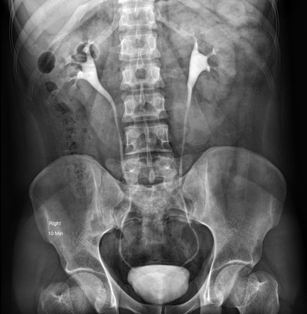 CT IVP / IVU (Intravenous Pyelogram/Urogram)