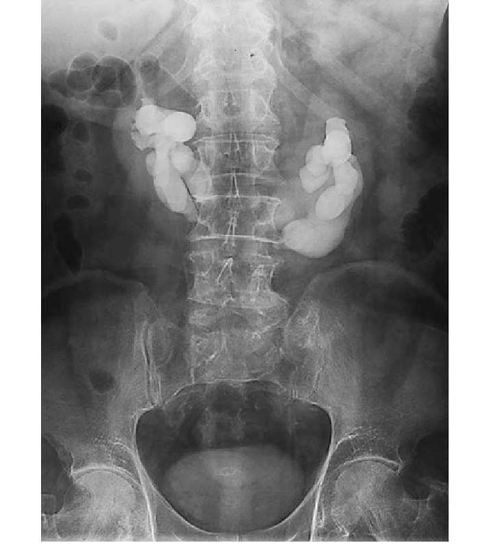 CT IVP / IVU (Intravenous Pyelogram/Urogram)