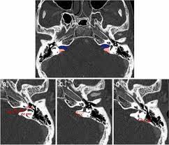 CT Internal Auditory Canal