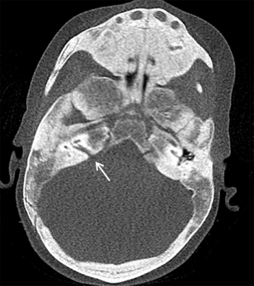 CT Internal Auditory Canal