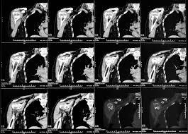 CT Joints (Single joints)