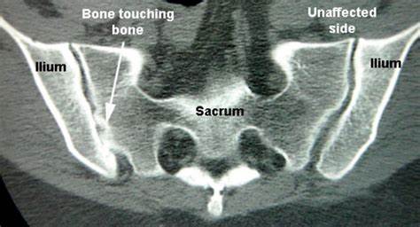 CT Joints (Single joints)