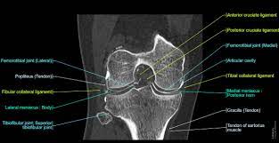 CT Knee (LEFT)