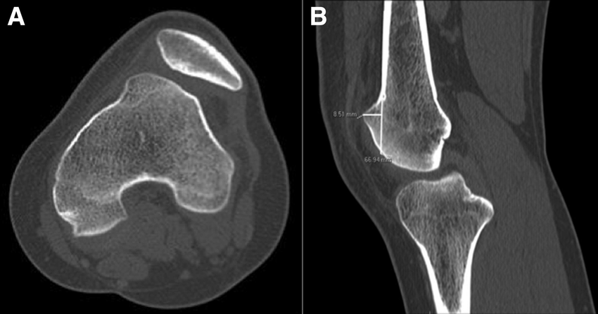 CT Knee (LEFT)