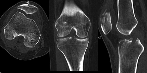 CT Knee (RIGHT)