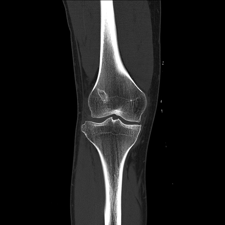 CT Knee (RIGHT)