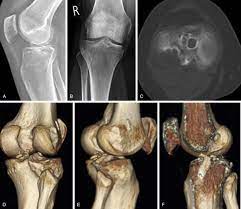 CT Knee