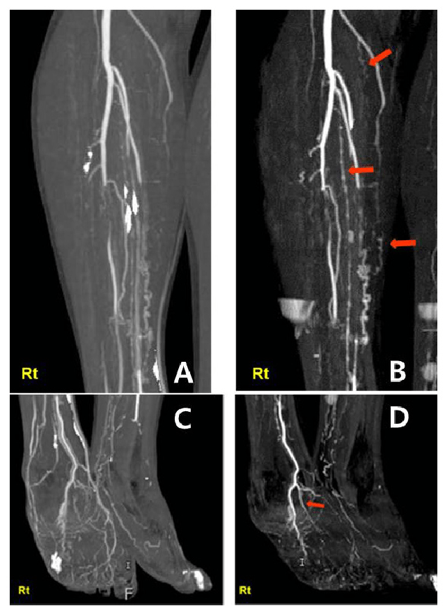 CT Leg RIGHT