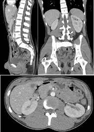 CT Lower Abdomen and Pelvis