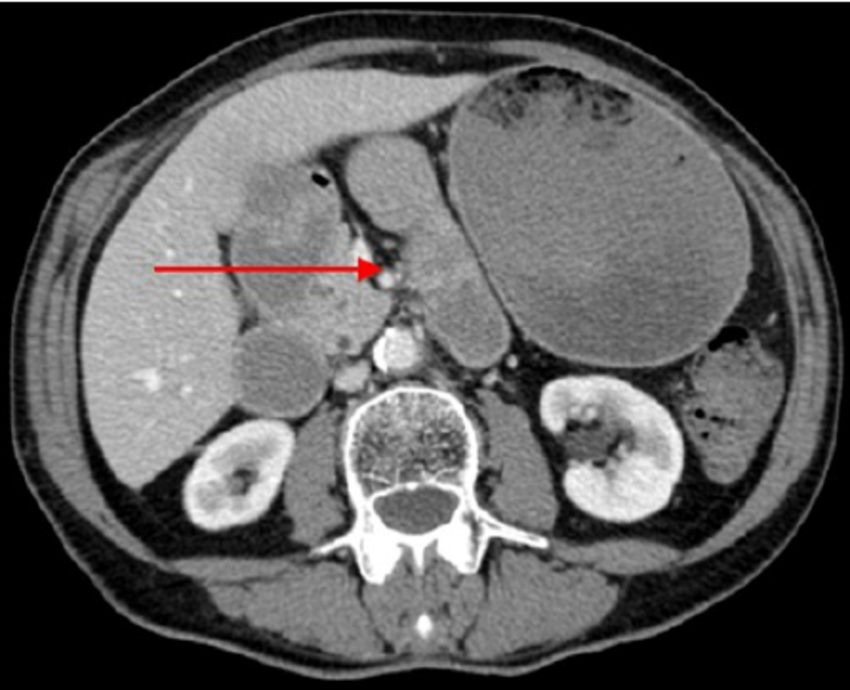 CT Lower Abdomen and Pelvis