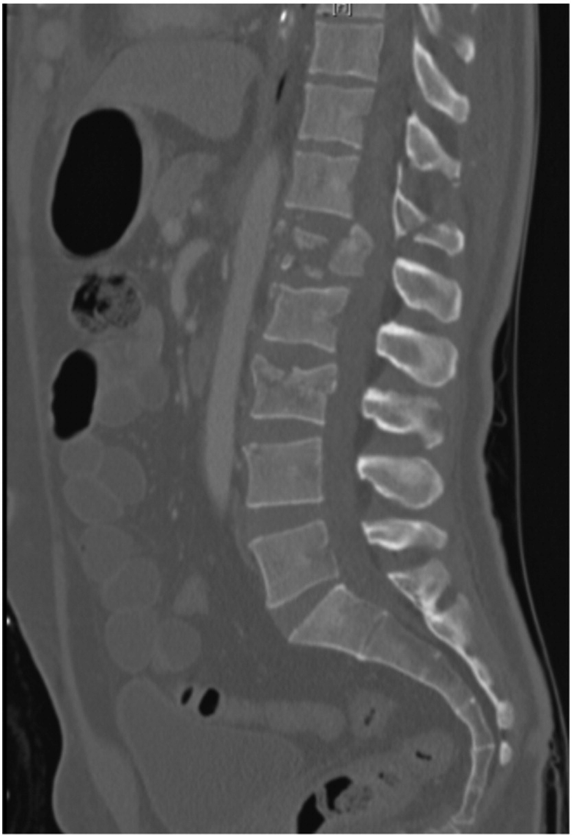 CT Lumbar Spine