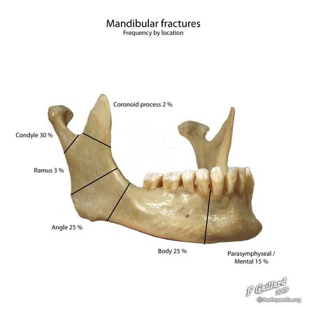 CT Mandible Bone