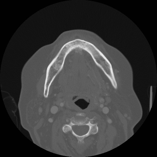 CT Mandible Bone