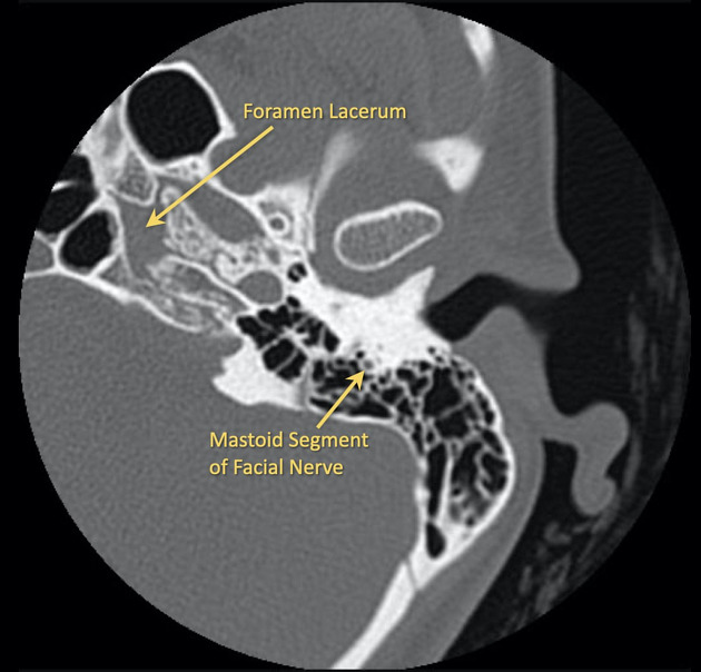 CT Mastoid