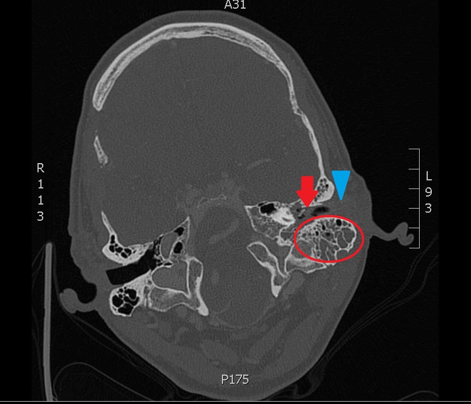 CT Mastoid