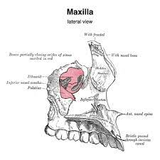 CT Maxilla